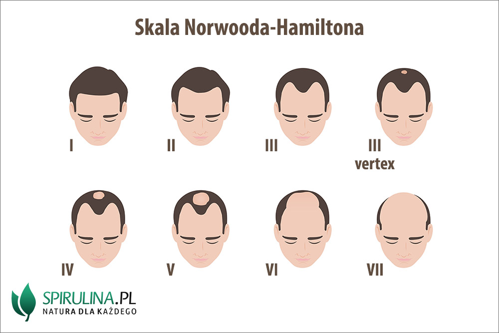 Skala Norwooda - Hamiltona